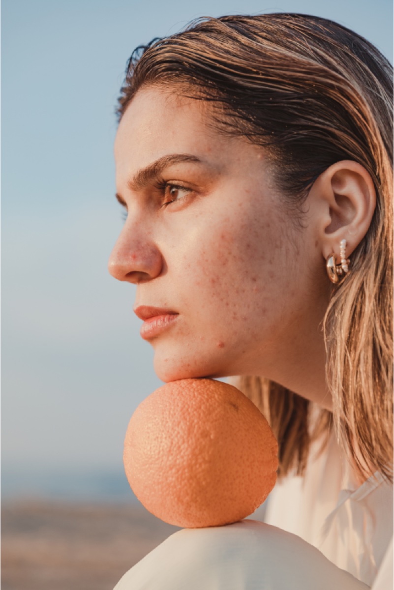 Blemish-prone Skin
